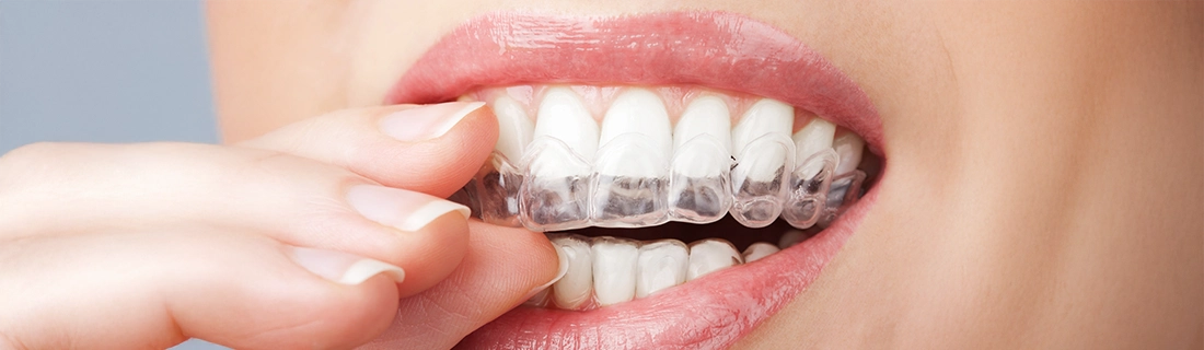 Clear Braces in Bala Cynwyd PA